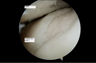 tipo de astroscope na articulación do xeonllo con como participar de 3º grao