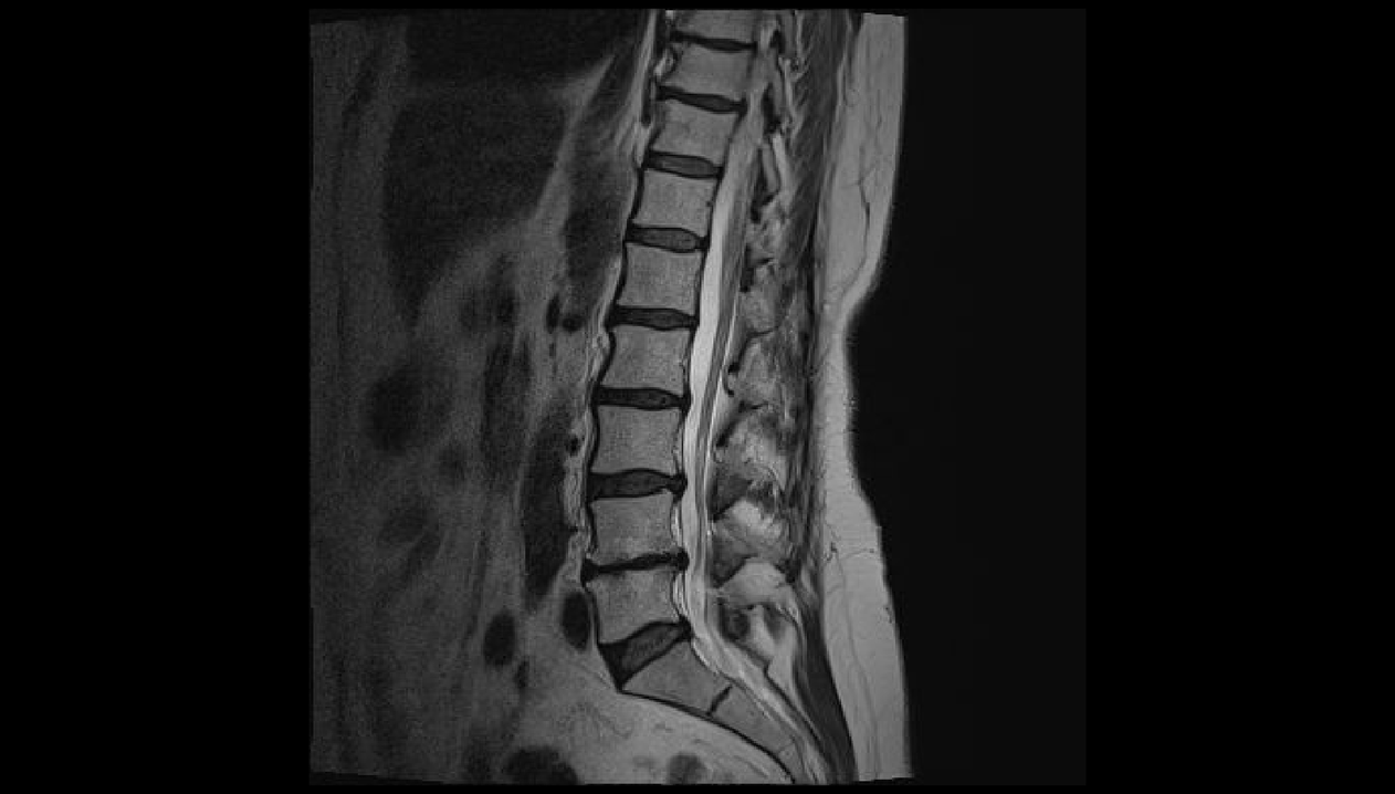 diagnóstico de dor lumbar na rexión lumbar