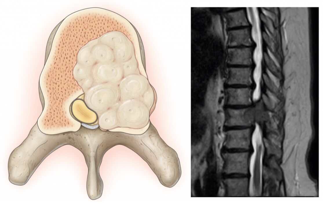 o inchazo da columna vertebral leva a dor nas costas