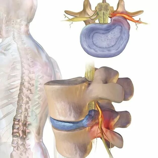 problemas de disco intervertebral