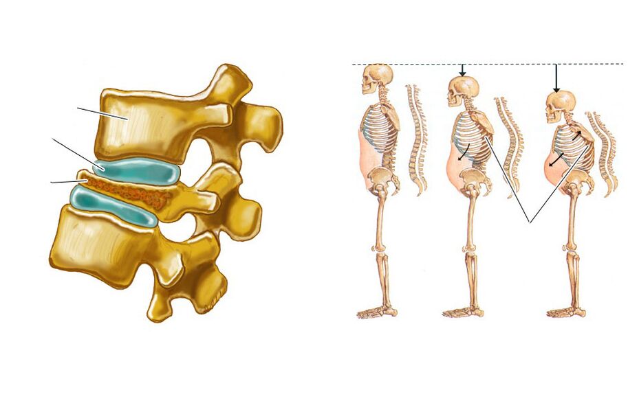 unha columna vertebral flácida provoca dor nas costas