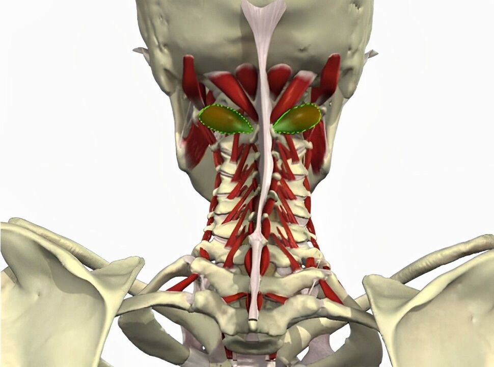 síndrome da arteria vertebral