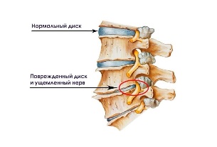 Síntomas de cervical enfermidade dexenerativa do disco