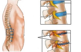 causas da osteocondrose da columna lumbar