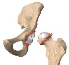 causas da artrose da articulación da cadeira