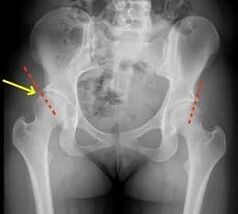 métodos de tratamento da artrose da articulación da cadeira