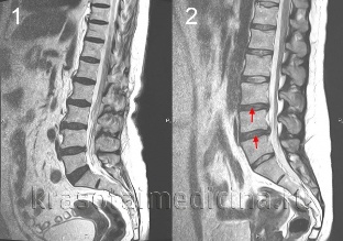 osteocondrose da columna vertebral