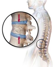 A osteoporose provoca dores nas costas na rexión lumbar